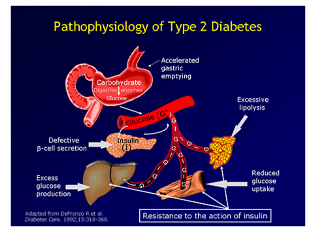 Pathophysiology Of Type 2 Diabetes Mellitus